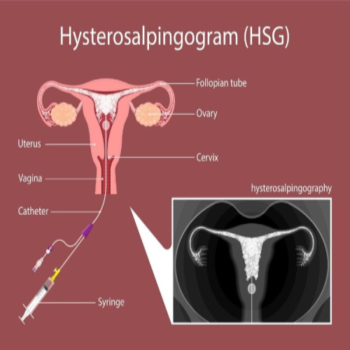 Fallopian Tube Testing