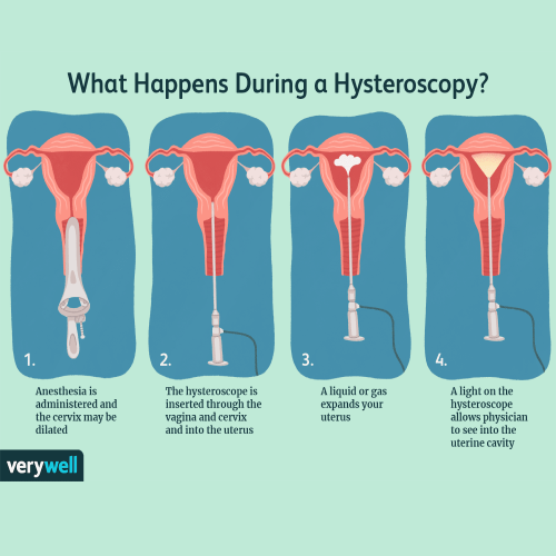 Hysteroscopy