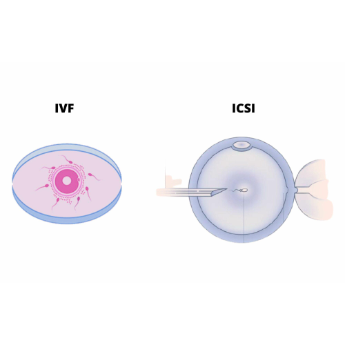 In-vitro Fertilization & ICSI