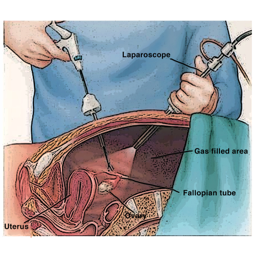 Laparoscopy