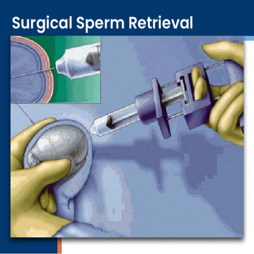 Surgical Sperm Retrieval